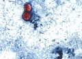 US-Behörden untersuchen neuen Parasitenausbruch mit 72 Erkrankten